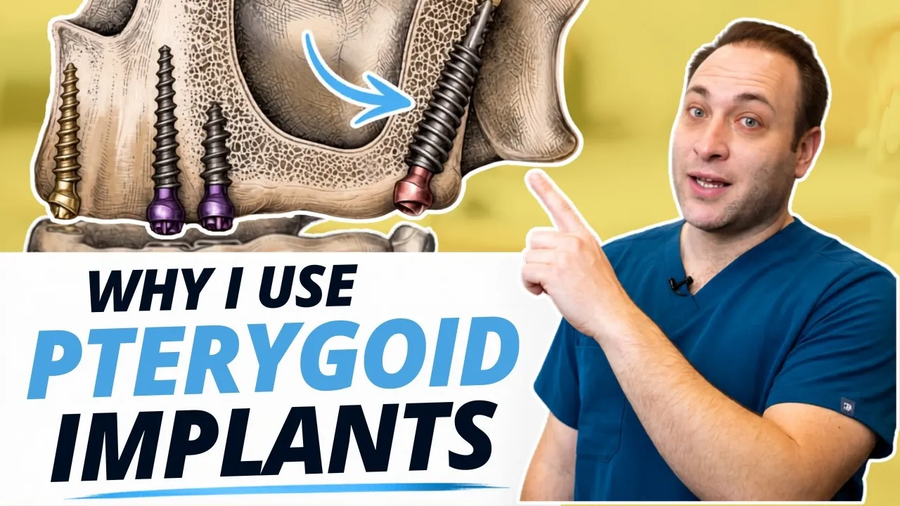 The Reason Pterygoid Implants Are Taking Over Modern Dentistry