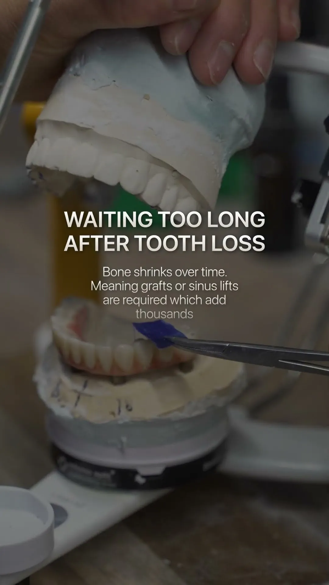 3 Mistakes That Cost You Thousands Before Getting Implants