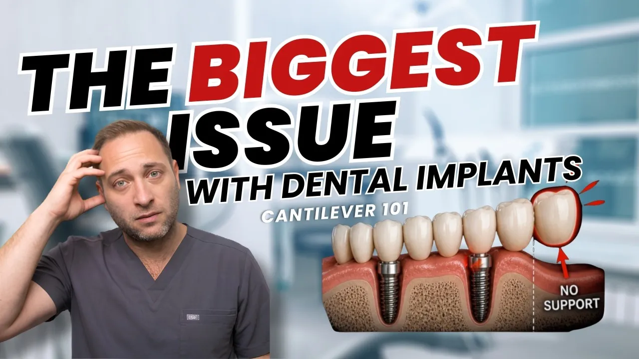The Hidden Problem With Full-Mouth Dental Implants: Cantilever Forces