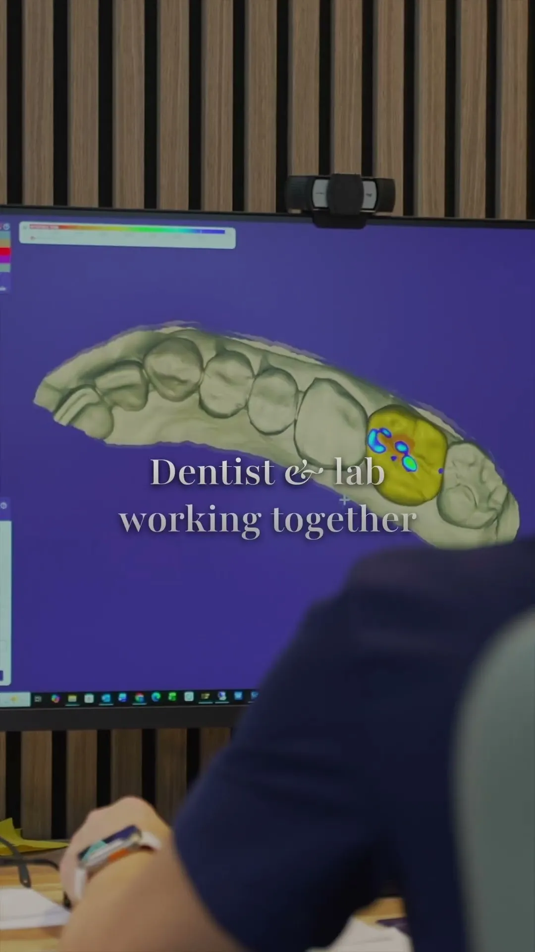 Why Some Dental Implants Look Better Than Others