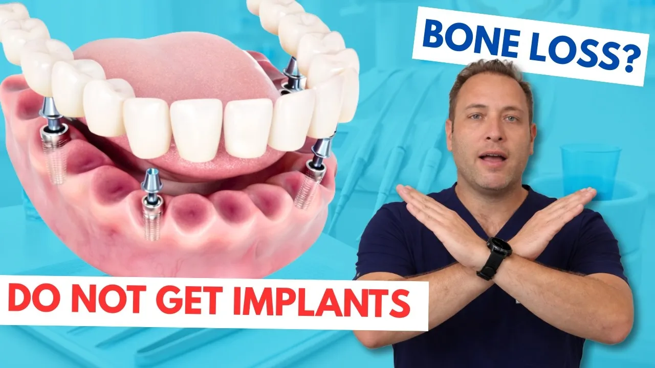 Don't Get Implants Until You Know This: What to Ask Before Choosing a Clinic